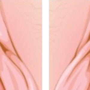 Capuzplastia