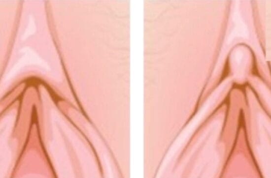 Capuzplastia