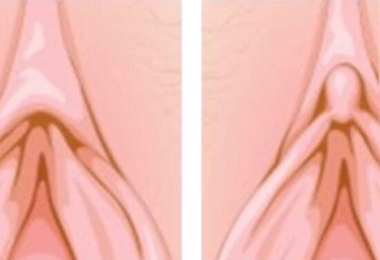 Capuzplastia