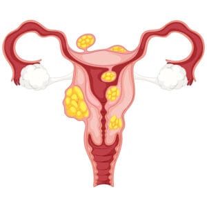 Mioma uterino