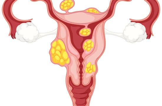 O Que é Mioma Uterino? Causas, Sintomas e Quando se Preocupar.