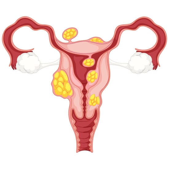 Mioma uterino