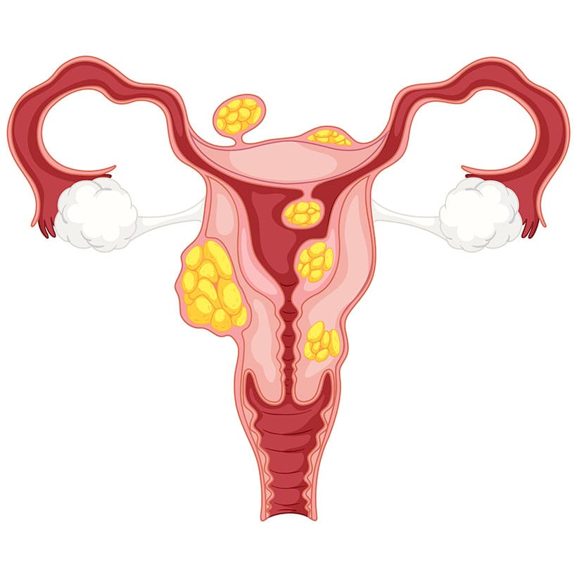 O Que é Mioma Uterino? Causas, Sintomas e Quando se Preocupar.